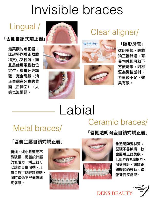 隱適美缺點有哪些？隱形牙套價格不便宜，患者要先了解矯正種類的優缺點，再做選擇。