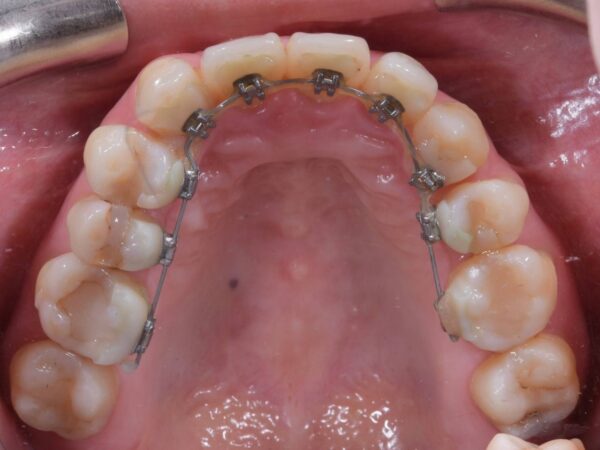 舌側矯正是將矯正器安置在牙齒的內側（舌側面），有別於一般矯正器是安置在牙齒的外側（唇側面），既可達到 矯正治療之目的，也可以將矯正器完全隱藏起來。