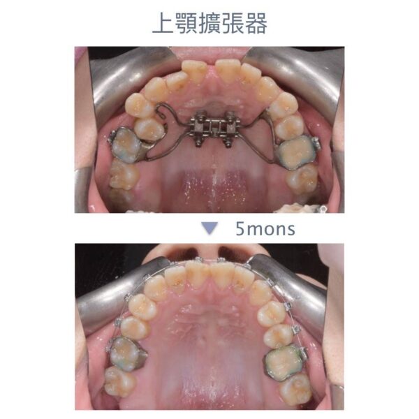 在兒童時期可藉牙弓擴張器，來刺激上顎骨縫合區的生長發育，配戴上顎擴張器數週後，可以有效的改善上顎牙弓窄小。