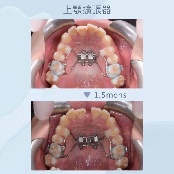 若要做大幅度的上顎骨擴張，往往必須藉由骨釘的力量來輔助解決，讓牙齒發揮正常功能。